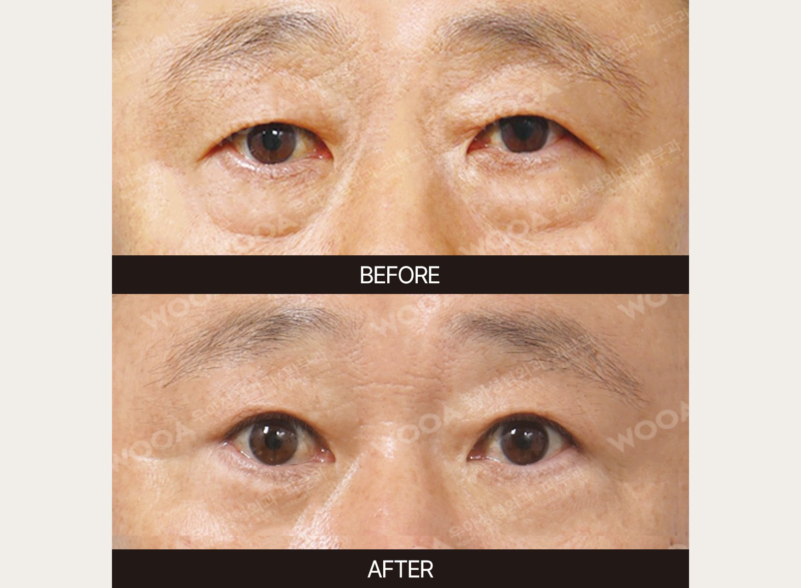 WOOA Plastic Surgery eyes before and after