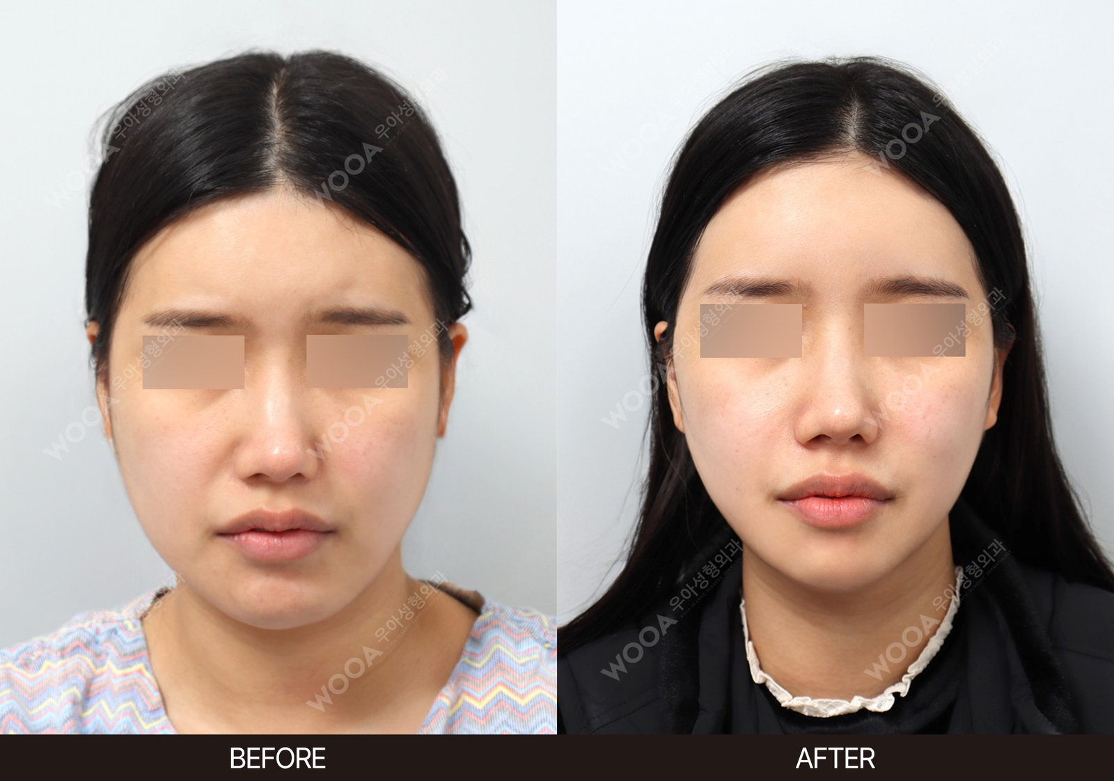 WOOA Plastic Surgery lifting before and after