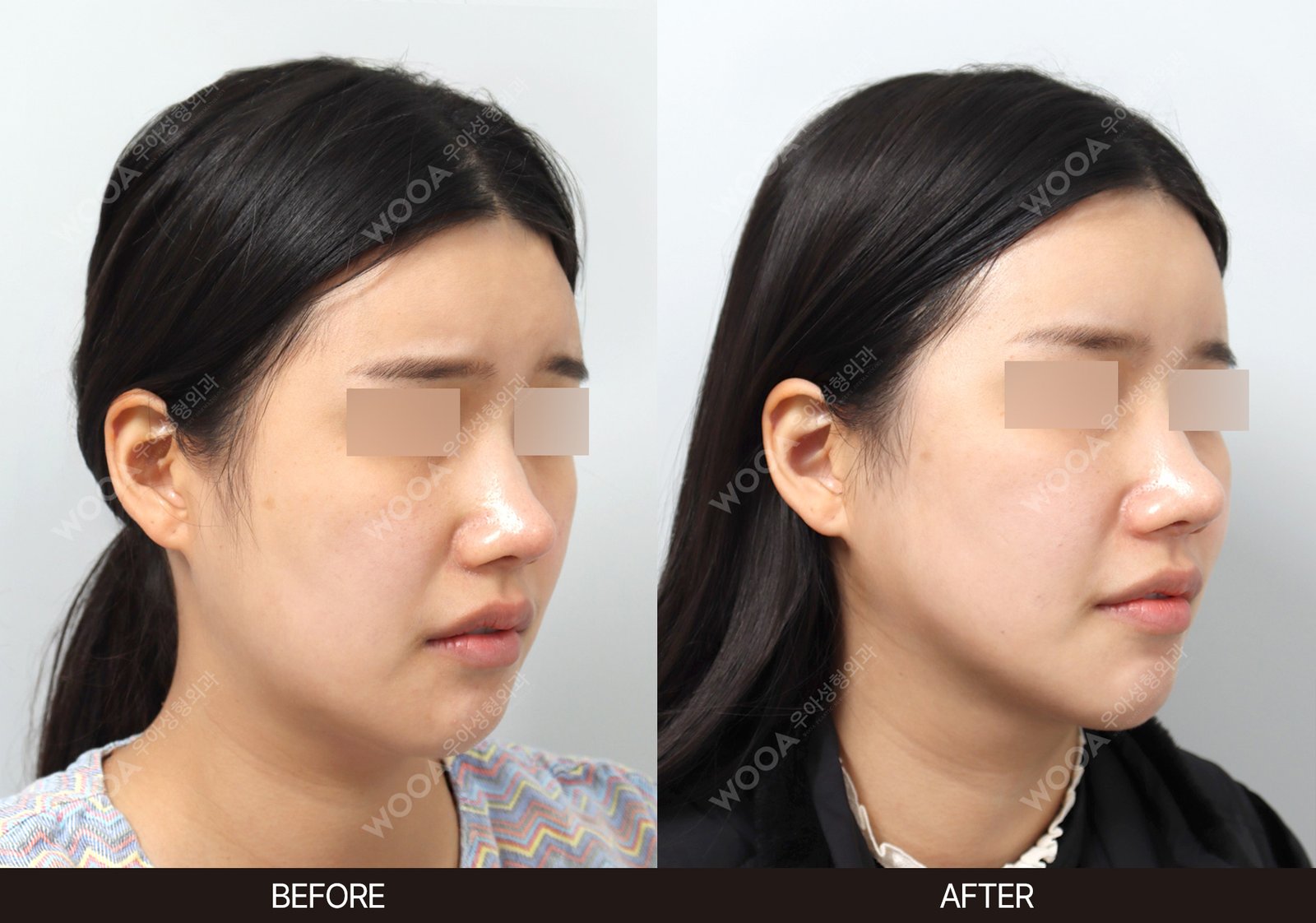 WOOA Plastic Surgery lifting before and after