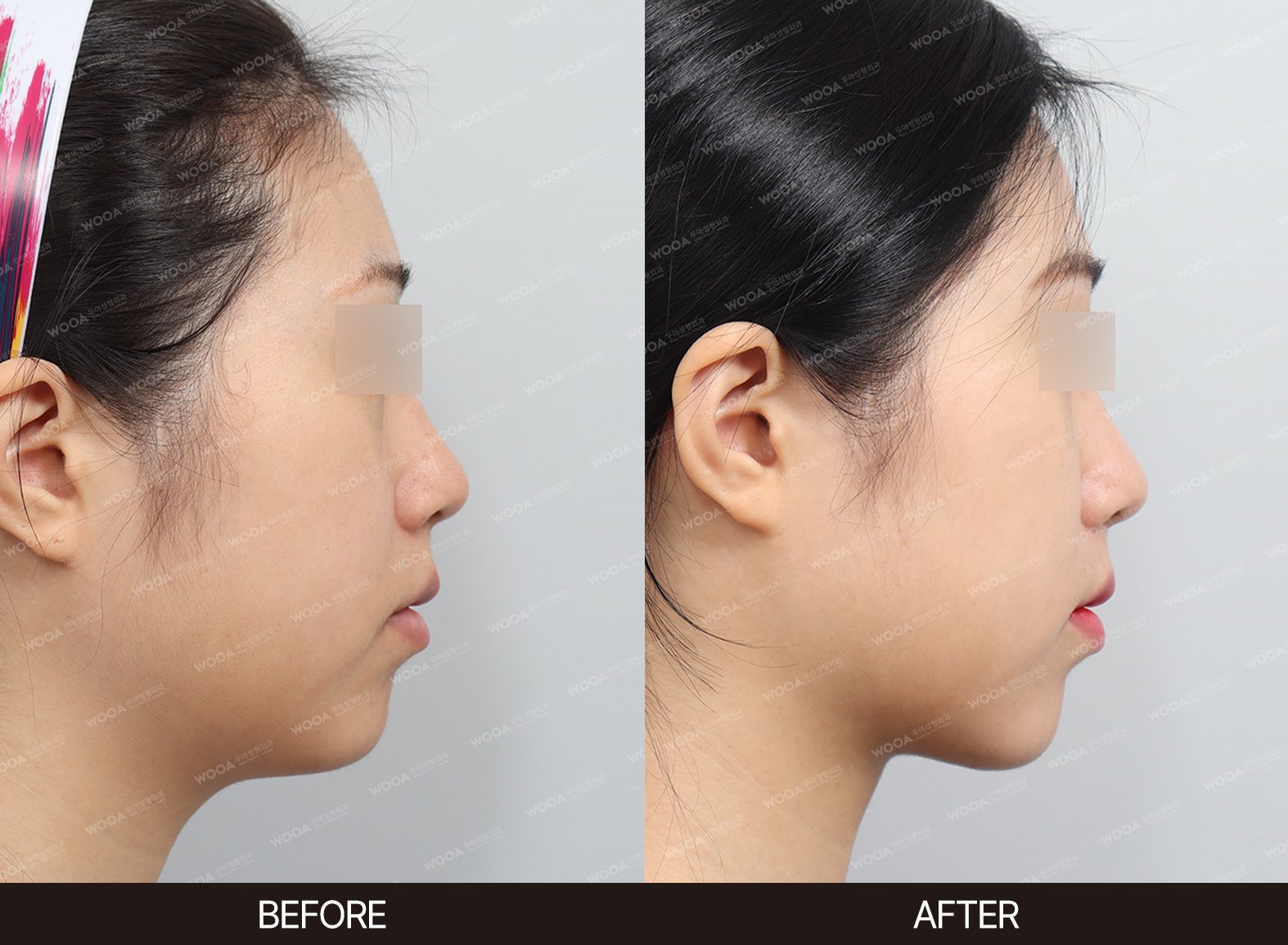 WOOA Plastic Surgery lifting before and after