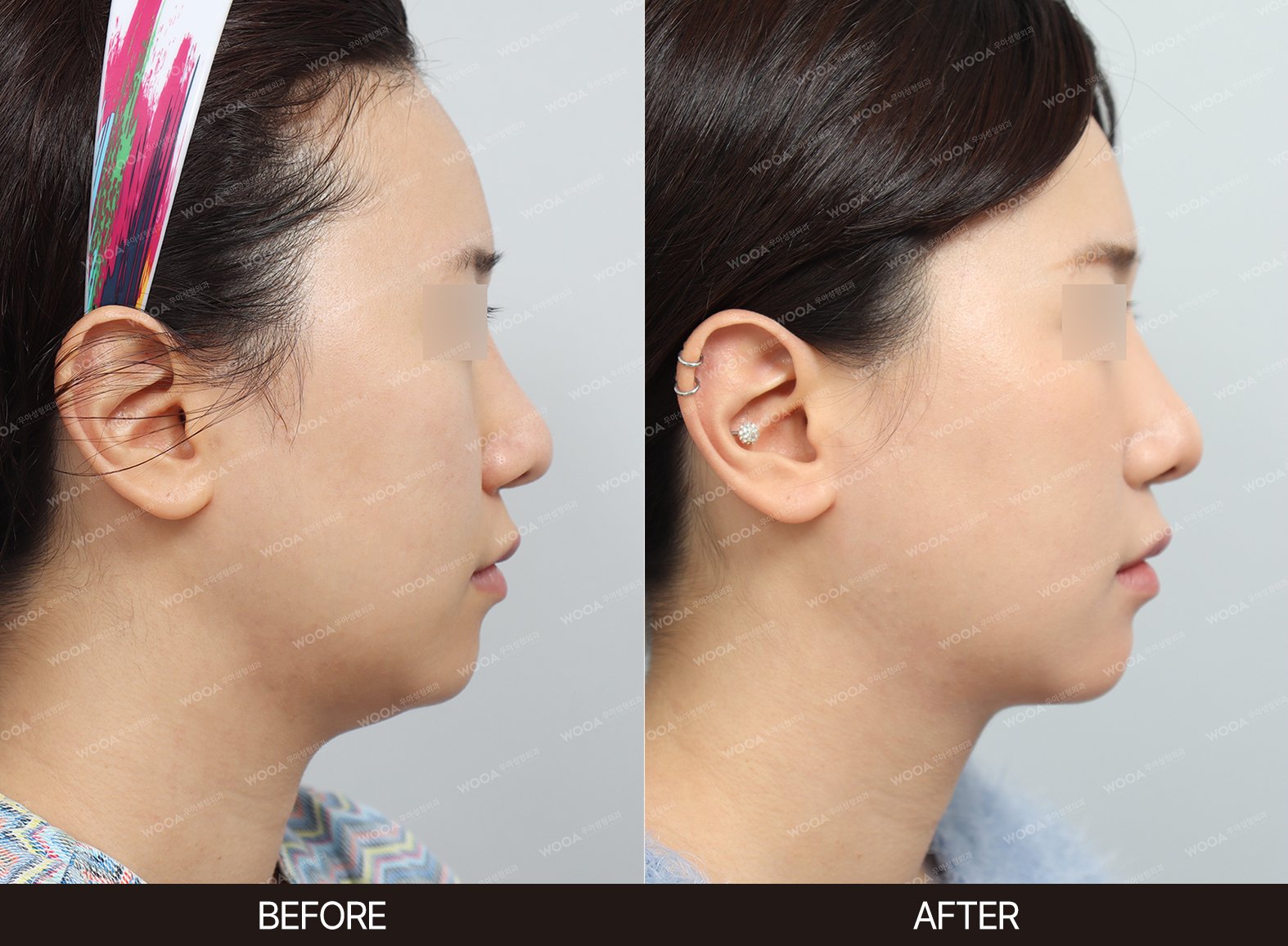 WOOA Plastic Surgery lifting before and after