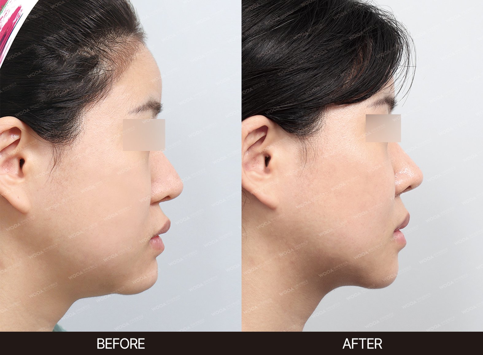 WOOA Plastic Surgery lifting before and after