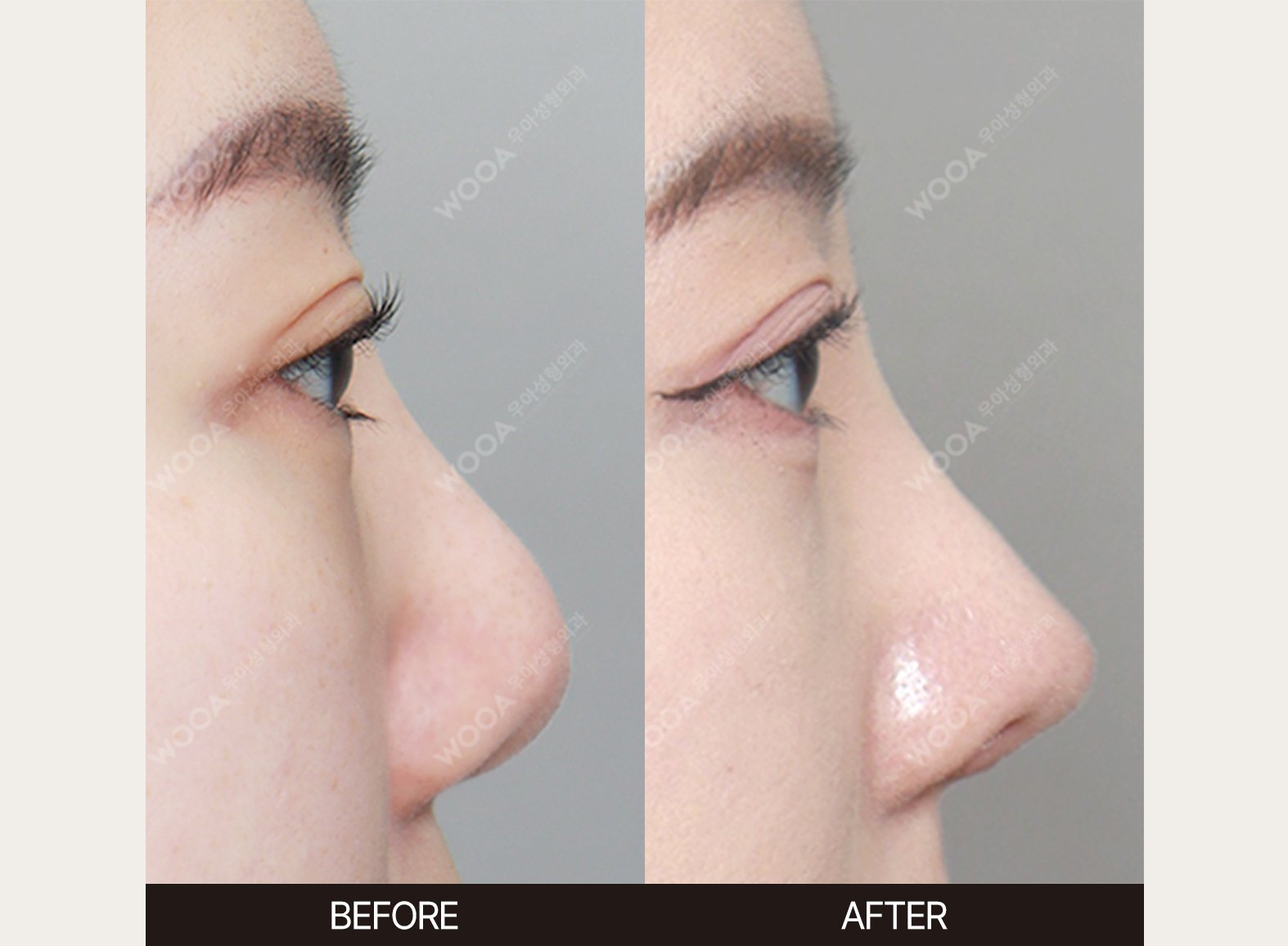 WOOA Plastic Surgery nose before and after