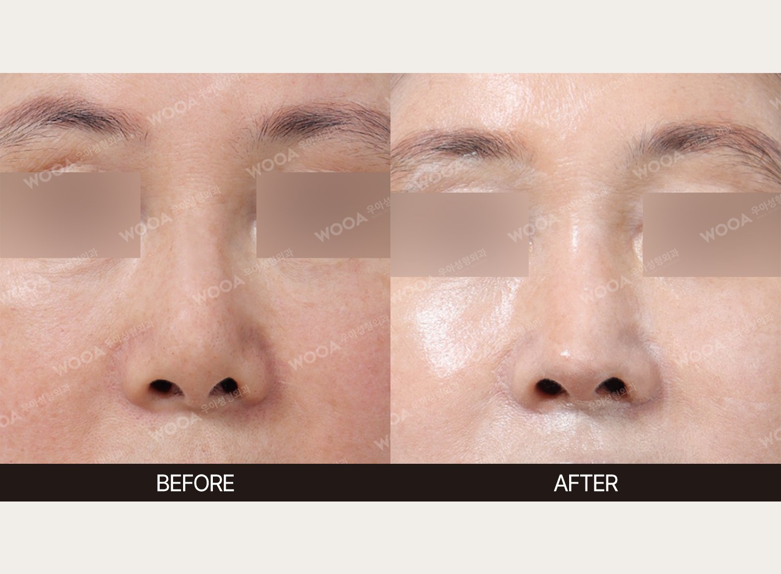 WOOA Plastic Surgery nose before and after