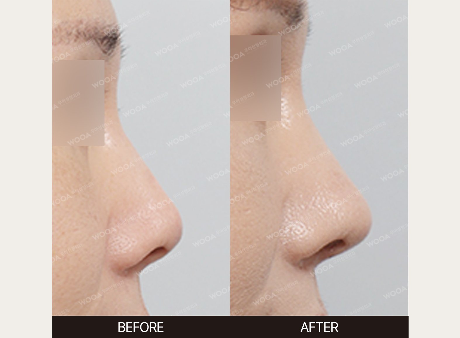 WOOA Plastic Surgery nose before and after