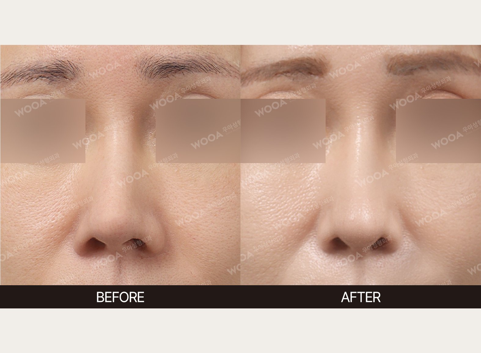 WOOA Plastic Surgery nose before and after