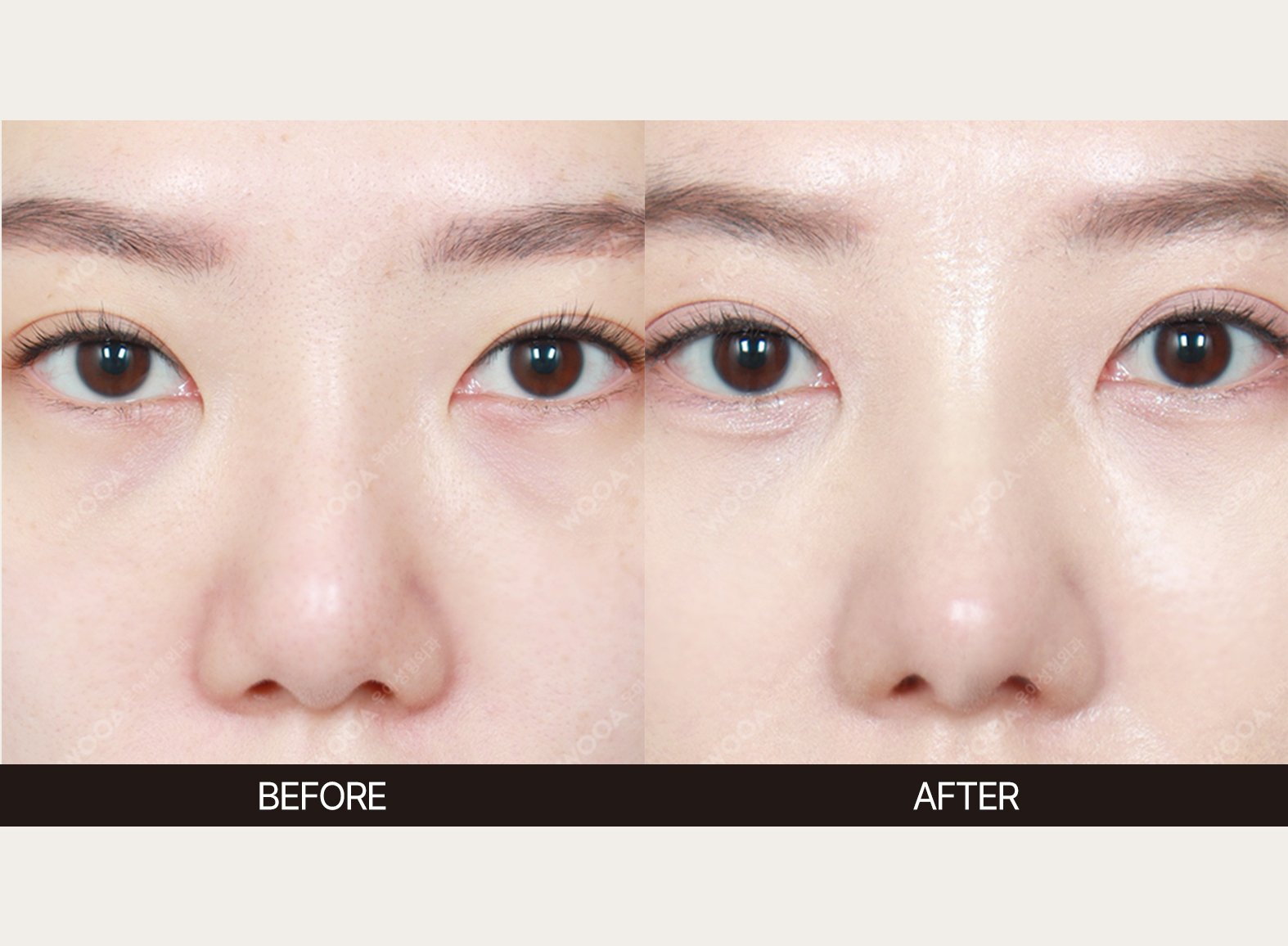 WOOA Plastic Surgery nose before and after