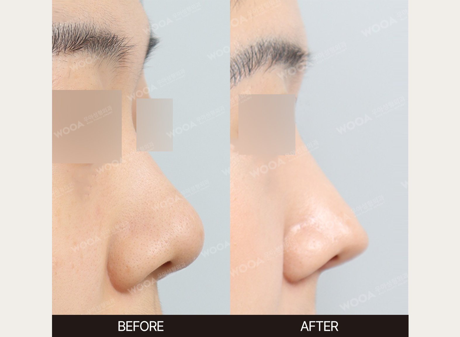 WOOA Plastic Surgery nose before and after