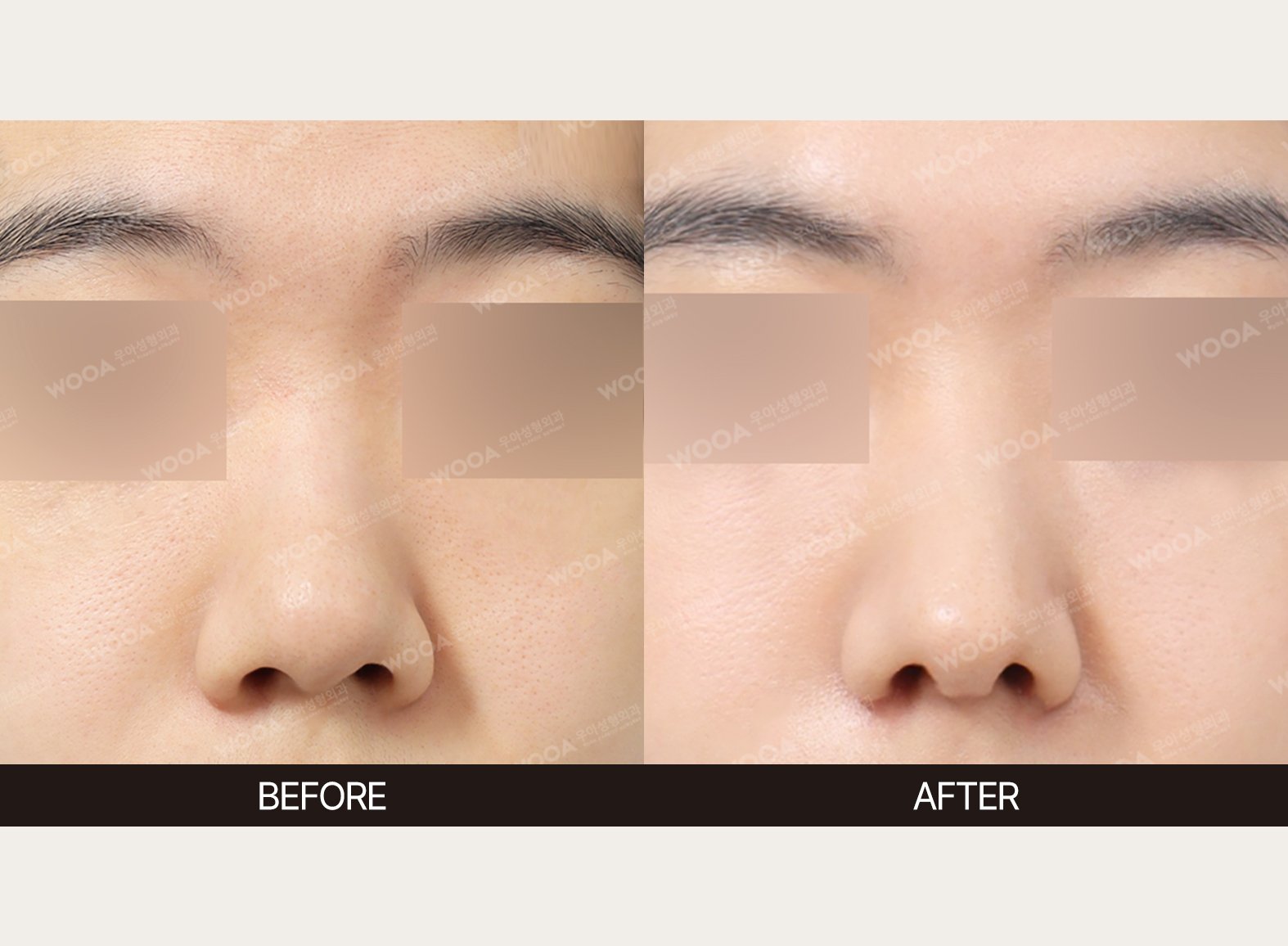 WOOA Plastic Surgery nose before and after