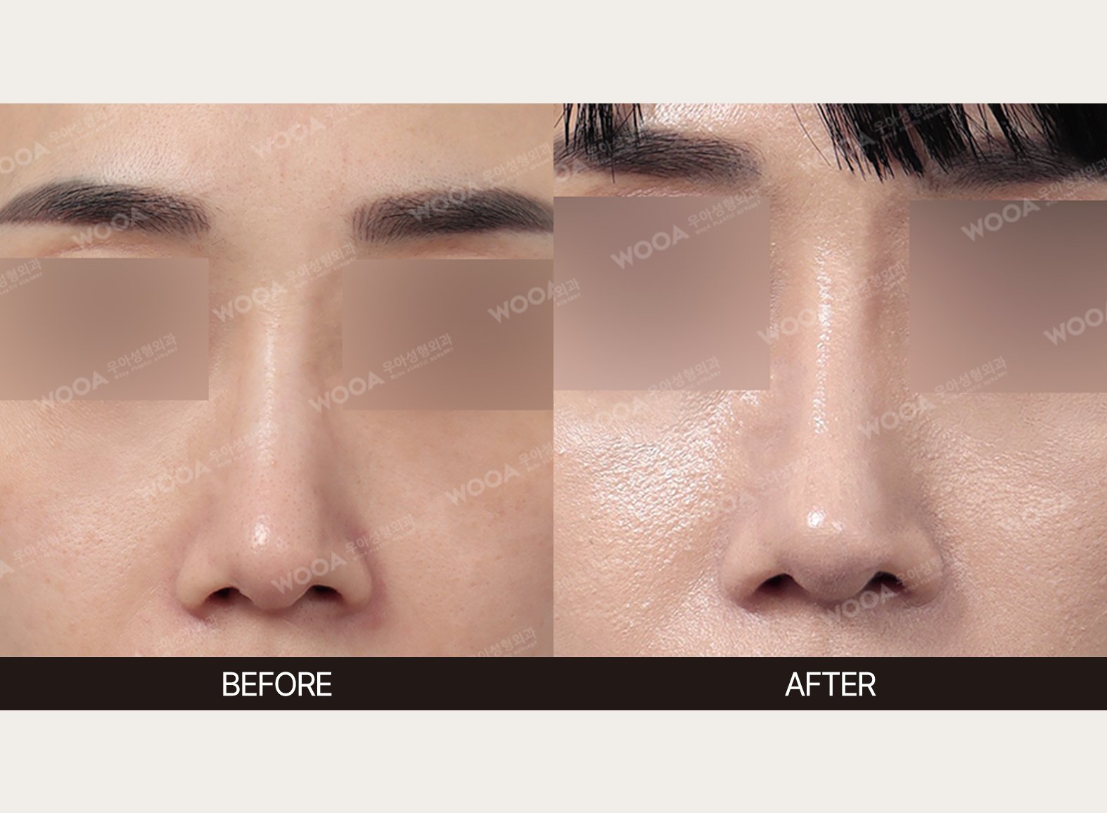 WOOA Plastic Surgery nose before and after