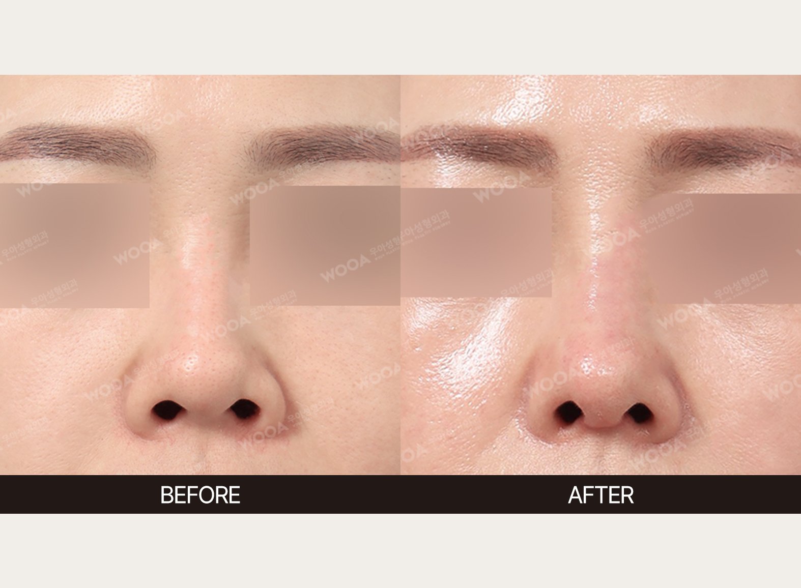 WOOA Plastic Surgery nose before and after