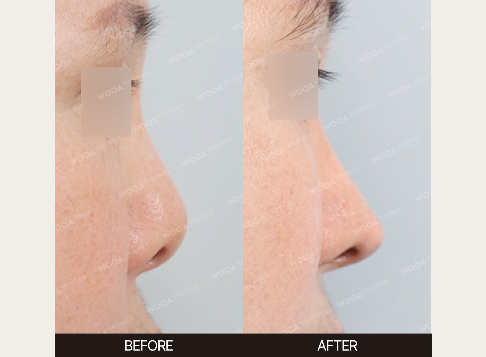 WOOA Plastic Surgery nose before and after