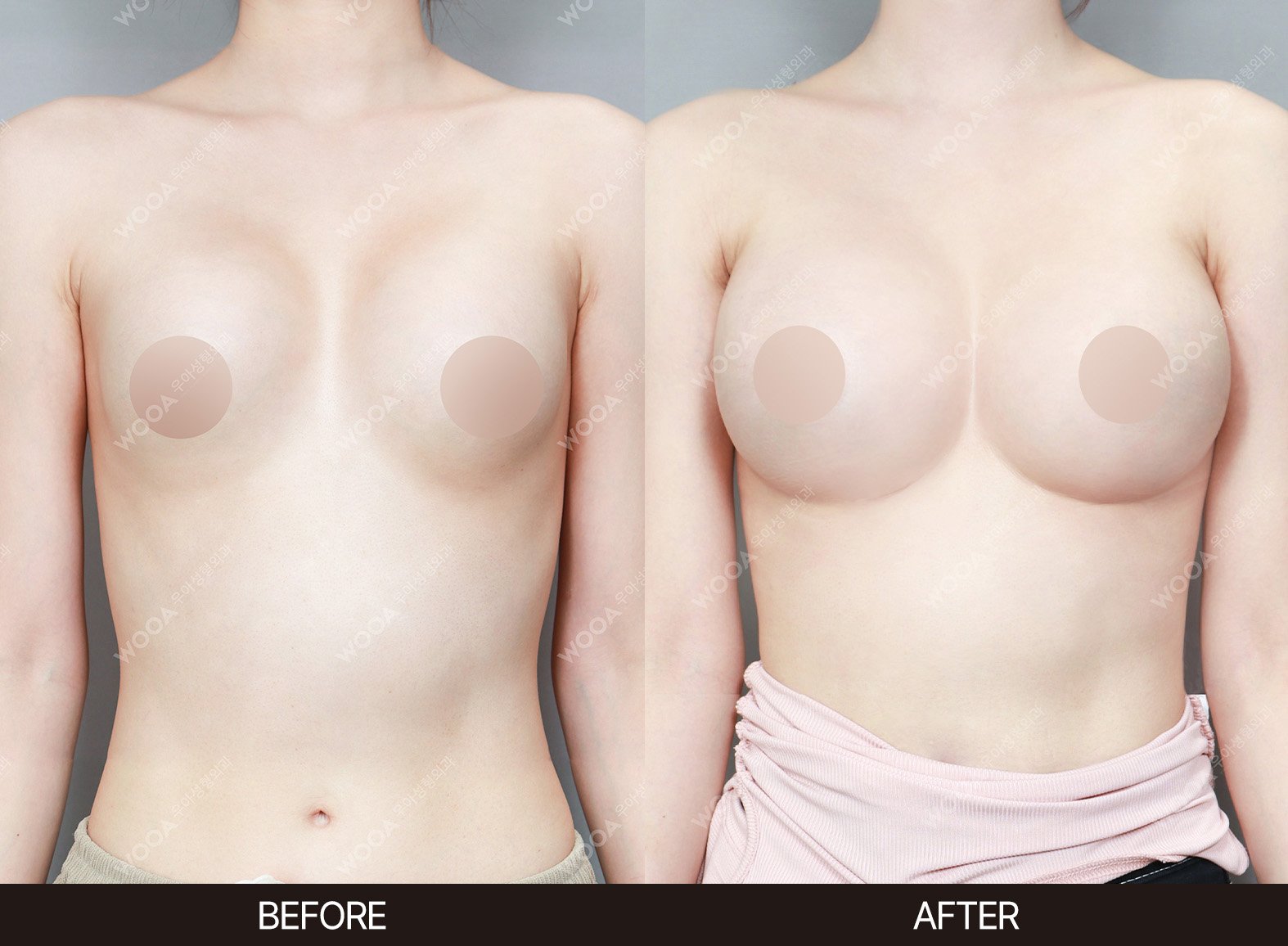 WOOA Plastic Surgery revision before and after