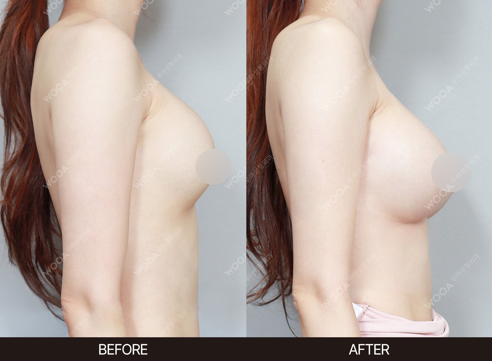 WOOA Plastic Surgery revision before and after