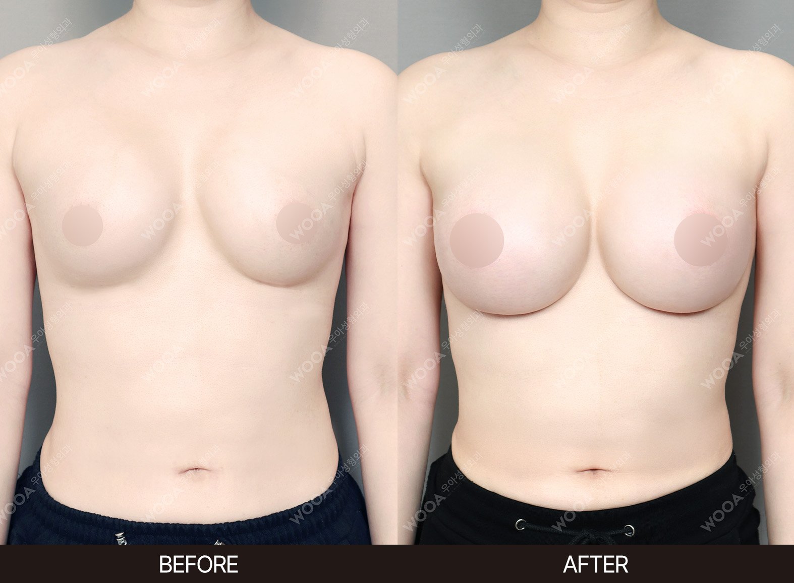 WOOA Plastic Surgery revision before and after