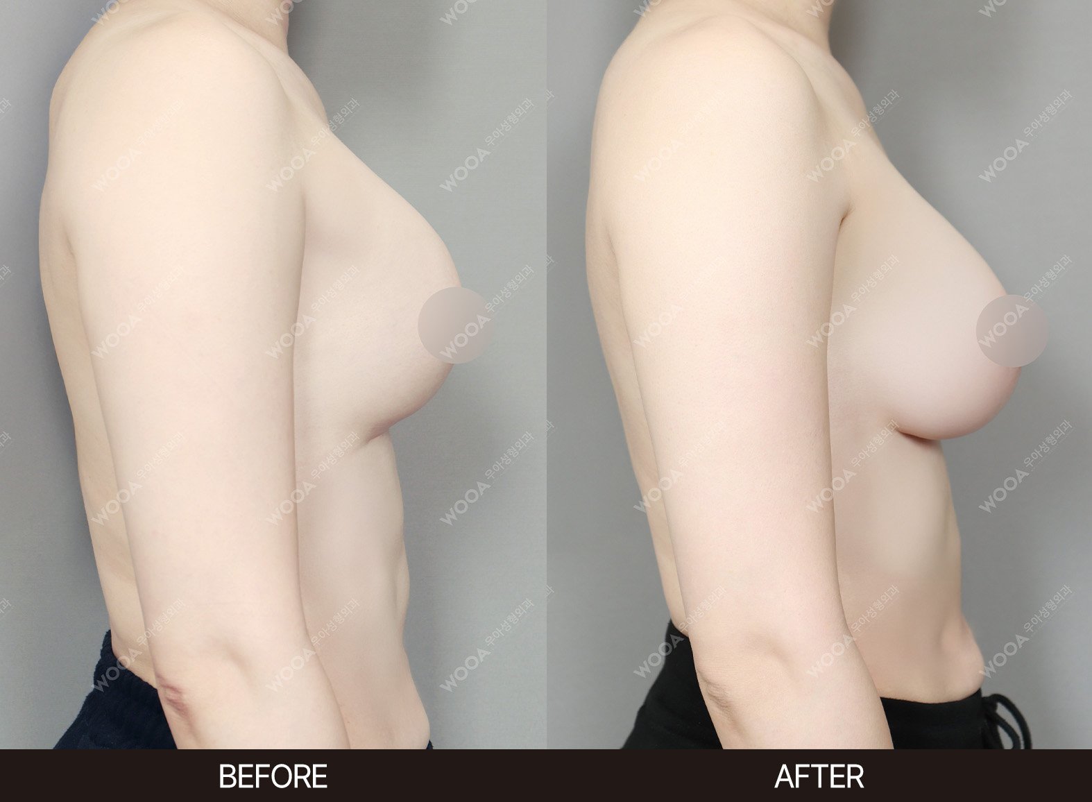 WOOA Plastic Surgery revision before and after