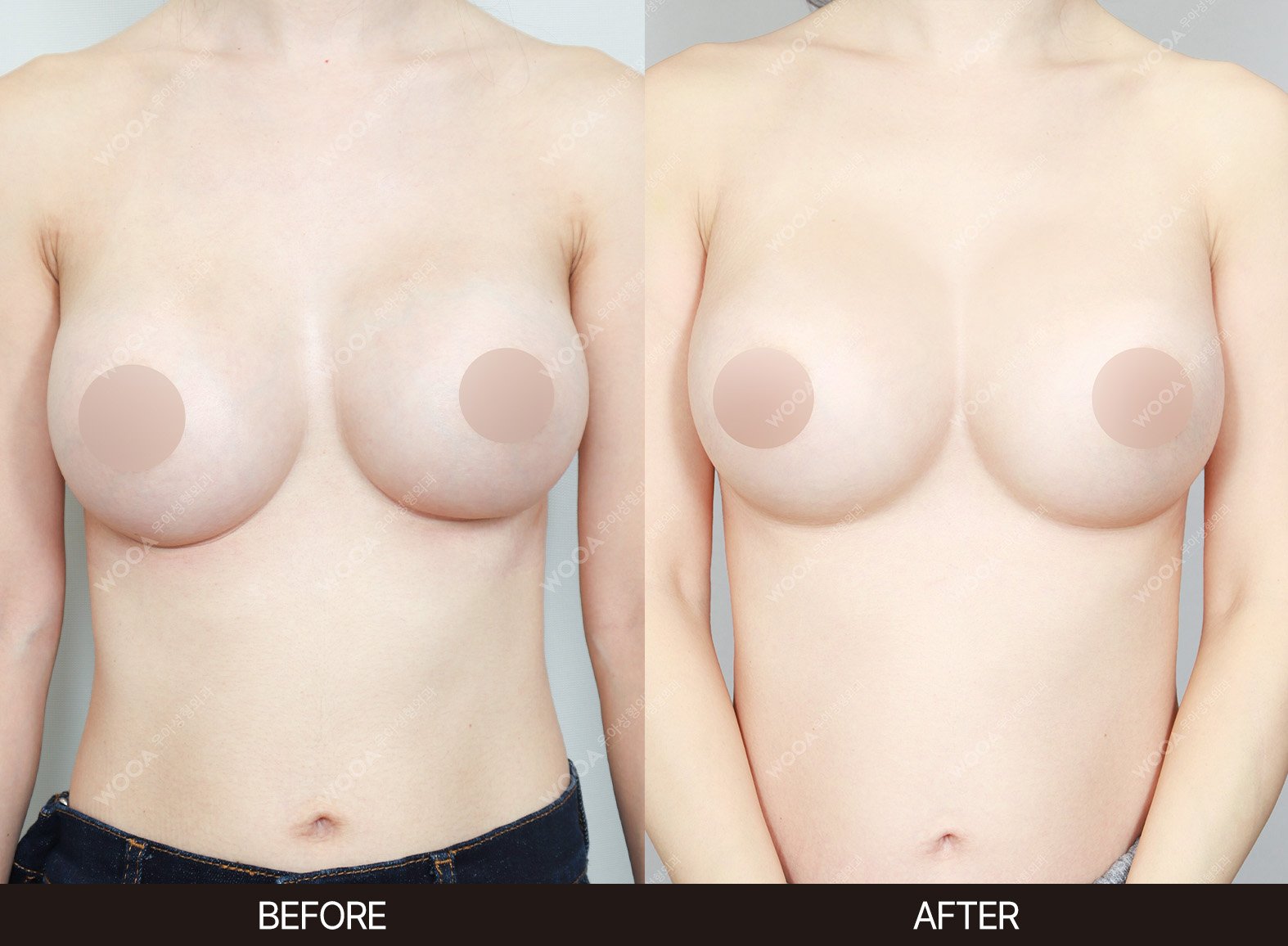 WOOA Plastic Surgery revision before and after