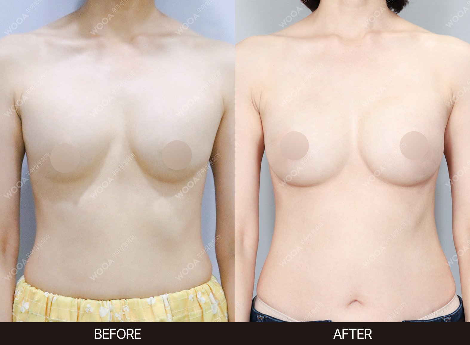 WOOA Plastic Surgery revision before and after